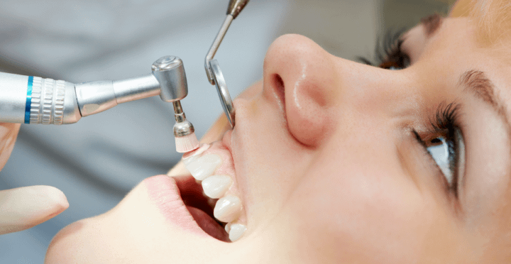 beneficios de una limpieza dental profesional